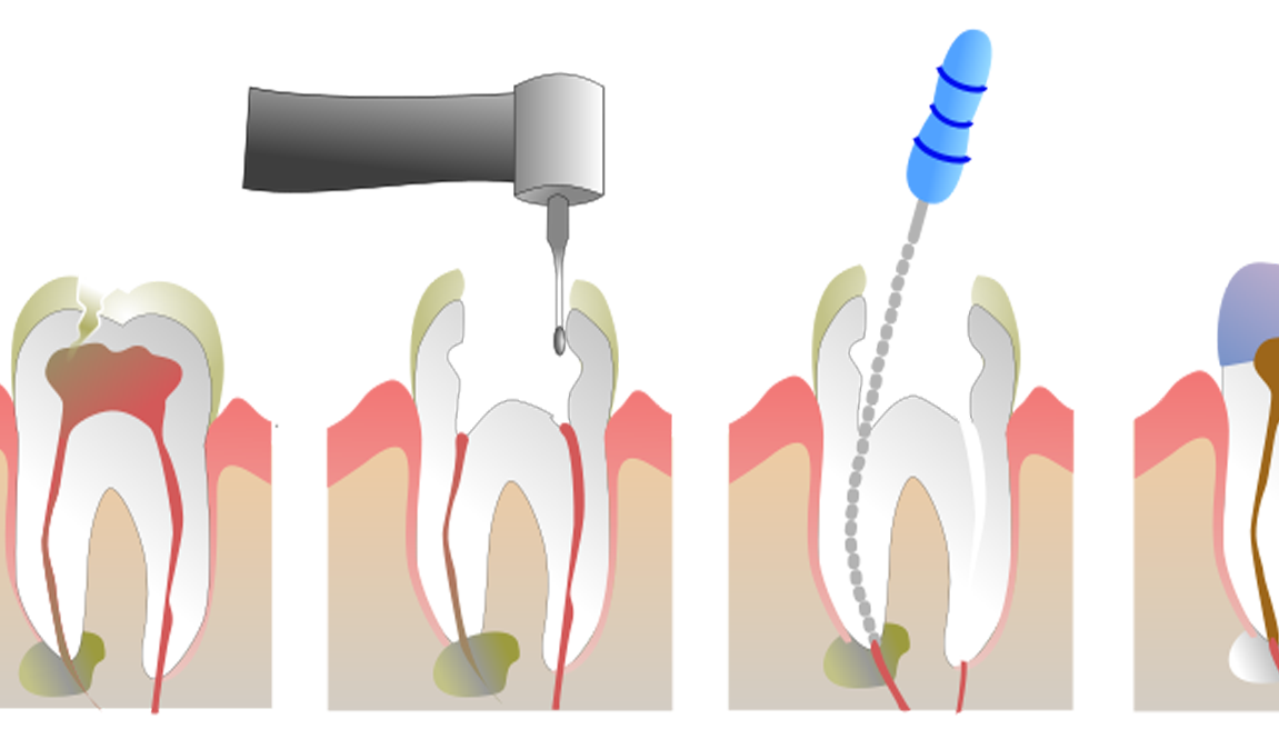 Clínica Dental Dr Salvador Bernabeu endodoncia